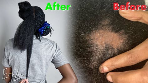 Scalp Care: Detox/Unclog Your Scalp for Extreme Growth and Volume | EfikZara Dry Flaky Scalp Remedy Black Hair, Remove Buildup From Scalp, Sebum Buildup On Scalp, Hair Growth Black Women, Scalp Detox For Hair Growth, Scalp Detox For Buildup, How To Clean Scalp Build Up, Dry Scalp Remedy, Scalp Cleanse