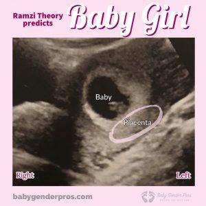 Ultrasound Gender Prediction, 6 Week Baby, Ramzi Theory, Ultrasound Gender, Baby Gender Predictor, Gender Determination, Obstetric Ultrasound, Gender Predictor, Baby Gender Prediction