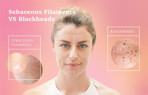 Do you have small, greyish dots on your nose that won't go away? These "blackheads" may actually be sebaceous filaments. Learn how to get rid of them! What Are Blackheads, Sebaceous Filaments, Face Steaming, Blackheads On Nose, Skincare 101, Facial Steaming, Clear Pores, Get Rid Of Blackheads, Oil Free Moisturizers