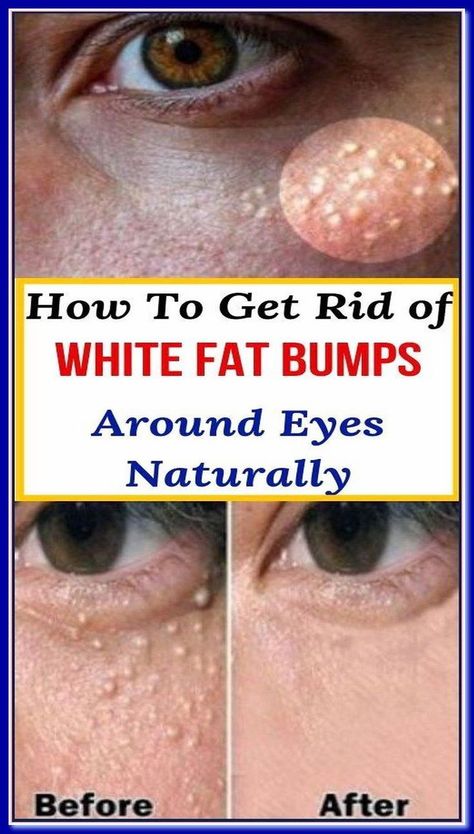 HOW TO GET RID OF WHITE FAT BUMPS AROUND EYES NATURALLY Bumps Under Eyes, Keto Diets, Medicine Book, Wellness Inspiration, Under Eyes, Skin Care Treatments, Skincare Tips, Skin Problems, Herbal Medicine