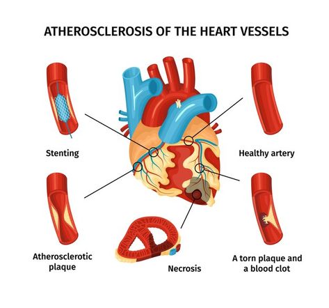 Aterosclerosi Vectors, Photos and PSD files | Free Download Heart Vessels, Heart Facts, Normal Values, Cardiac Disease, Coronary Artery, Lung Infection, Types Of Surgery, Heart Muscle, Coronary Arteries