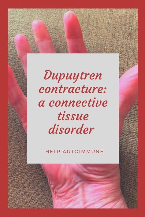 Connective Tissue Disorder, Dupuytren's Contracture, Paleo Autoimmune Protocol, Autoimmune Recipes, Autoimmune Diet, Gastrointestinal Disorders, Thyroid Issues, Autoimmune Protocol, Connective Tissue