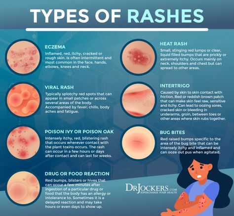 Viral Rash, Types Of Skin Rashes, Fungal Rash, Types Of Rashes, High Histamine Foods, Bajaj Finserv, Rash Causes, Bubble Skincare, Low Histamine Diet