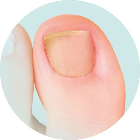 Nail Infection Bluish Nails, White Spots On Toenails, White Spots On Nails, Ugly Toenails, Toenail Problems, Yellow Toe Nails, Pale Nails, Toenail Health, Nail Signs