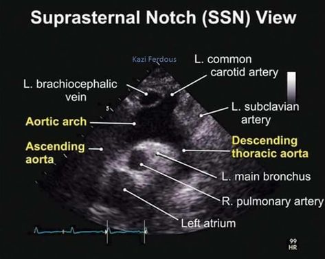 Suprasternal Notch View TEE Cardio Sonography, Echo Ultrasound, Ultrasound Humor, Family Practice Medicine, Diagnostic Medical Sonography Student, Ultrasound Physics, Cardiac Sonography, Nerdy Nurse, Sonography Student