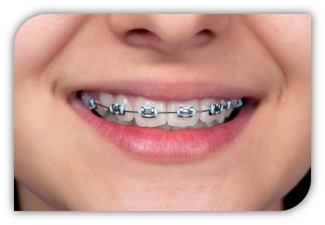 https://orthodontistsaratoga.wordpress.com/2015/07/13/why-do-so-many-people-get-braces-as-children/ orthodontist Saratoga Kawat Gigi, Braces Cost, Cute Braces Colors, Adult Braces, Kids Braces, Getting Braces, Kedokteran Gigi, Kesehatan Gigi, Cute Braces