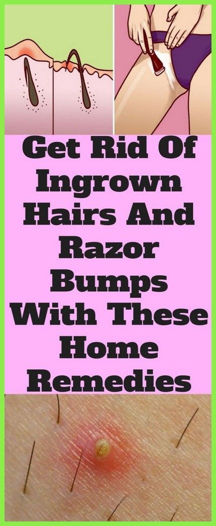 Get Rid Of Ingrown Hairs, Ingrown Hair Remedies, Diy Scrubs, Ingrown Hairs, Razor Bumps, Diy Remedies, Hair Help, Natural Health Tips, Healthy Lifestyle Motivation