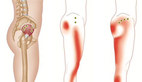 Treating the Gluteus Minimus Gluteus Minimus, Thoracic Outlet, Greater Trochanter, Bursitis Hip, Referred Pain, Fitness Board, Gluteal Muscles, Leg Cast, Hip Surgery