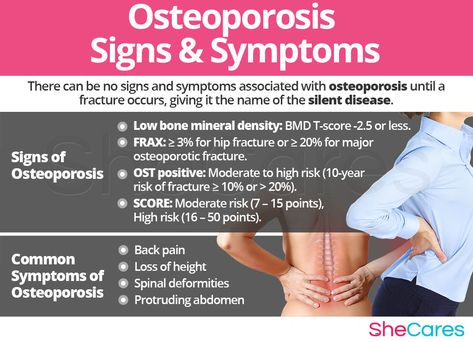 Because each woman's body is different, each one will experience possible progression of osteoporosis differently. However, keep in mind that often times, there are no signs and symptoms associated with osteoporosis until a fracture occurs, giving it the name of the silent disease. Osteoporosis Symptoms, Medical Laboratory Science Student, Hip Fracture, Inner Health, Medical Laboratory Science, Hormonal Imbalance, Bone Diseases, Spine Surgery, Good Nutrition