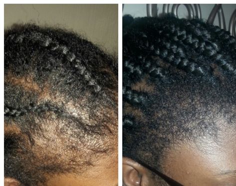 Hair Growth Pictures, Grow Edges, Herbs For Hair Growth, 4c Hair Care, Black Hair Growth, Castor Oil For Hair Growth, Mint Hair, Castor Oil For Hair, Jamaican Black Castor Oil