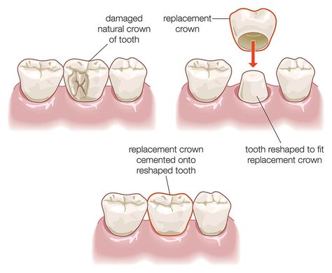 Dental Crown Procedure, Dentist Branding, Dental Pictures, Natural Crown, Tooth Crown, Dental Aesthetics, Discolored Teeth, Dental Fillings, Dental Cavities