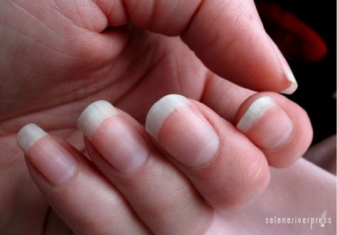 Have You Heard What Your Fingernails Are Saying About You? Nail Whitening, Nail Conditions, Long Fingernails, Nail Infection, Fungal Nail, Nagel Tips, Popular Nail Designs, Toenail Fungus, Nail Growth