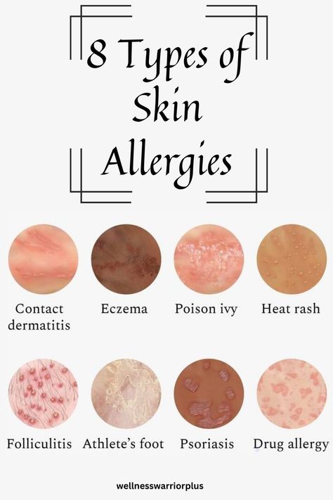 Types of Skin Allergies Types Of Skin Rashes, Common Triggers, Skin Allergy, Heat Rash, Skin Rashes, Types Of Skin, Athletes Foot, Body Hair Removal, Skin Allergies