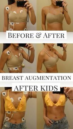 Increase Bust Size, Mommy Makeover Surgery, Breast Lift Surgery, Silicone Implants, Yoga Kundalini, Mommy Makeover, Breast Reduction, Breast Surgery, Breast Lift