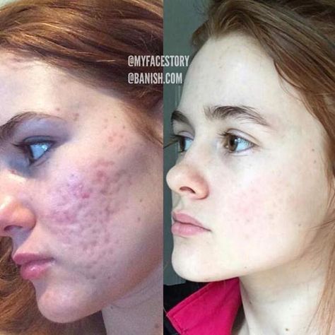 Acne Scar Cream, Acne Scar Mask, Before And After Pics, Acne Scar, Severe Acne, Acne Scar Removal, Derma Roller, Cystic Acne, Acne Remedies