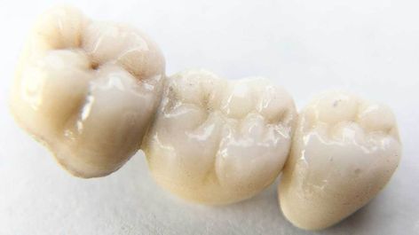 Dental Bridge: 4 Types, Benefits, Use Case and Costs Tooth Bridge, Wisdom Teeth Pain Relief, Dental Bridge Cost, Wisdom Teeth Pain, Tooth Pain Relief, Sensitive Teeth Remedy, Dental Implants Cost, Partial Dentures, Teeth Implants