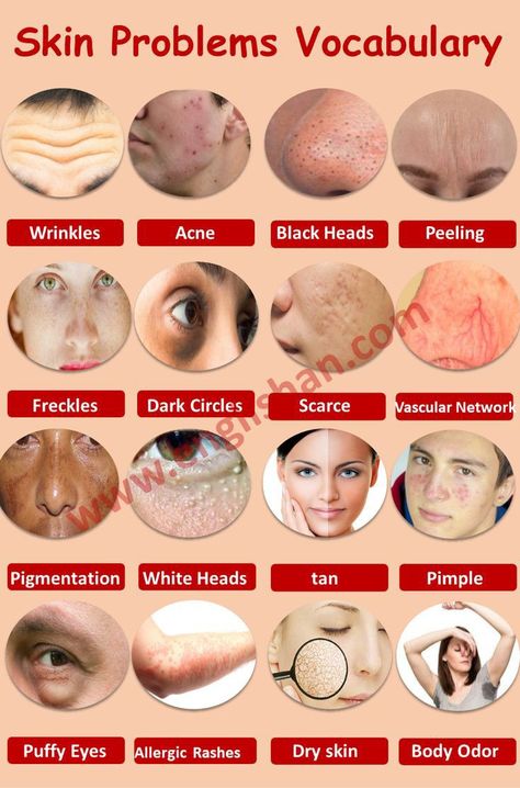 Letter In English, Hair Diseases, Hair Problem, Blackhead Remedies, Words List, Blackheads On Nose, Skin Advice, Acne Help, Natural Skin Care Remedies