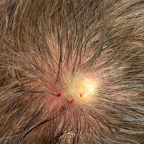 Cyst (Vanilla Pudding) Squeeze, Pop and Excision From Top of Skull  A cyst is an abnormal closed, hollow, and membranous sac filled with air, bodily fluids, keratin, and/or pus if the cyst has ever been infected.  #JochenMD #ContourDerm #cyst #senggugut #fibroid #pimplepopper #acne #blackheads #kembalidara #menstrualpro #wpro #ubatkuatkanrahim #pimplepoppimples #pimple #pimplepopping #ramping #jamuwanita #malampertama #sekatseleramakan https://video.buffer.com/v/5dc9e4771ea56a069e4e0e59 Elegantes Makeup, Aesthetic Skincare, Skin Color Palette, Care Aesthetic, Homecoming Makeup Browneyes, Skincare Aesthetic, Skin Care Order, Skincare Organization, Hoco Makeup