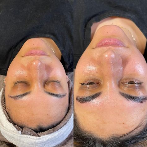 My beautiful client got a dermaplane facial, lash lift, and brow lam & tint! The before and afters really show how dermaplaning exfoliates the top layer of skin to reveal the glow from underneath! You can also see the texture change from before and after on the forehead and cheeks to a smooth finish! #esthetician #dermaplaning #estheticianlife #dermaplaningfacial #glowfacial #laslifting #browlamination #browshaping #browlift #browlam Dermaplane Facial, Facial Before And After, Brow Lift, Brow Lamination, Brow Shaping, Layers Of Skin, Lash Lift, The Glow, Esthetician