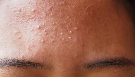 How to Treat Fungal Acne on Face - Pandia Health Anti Fungal Diet, Fungal Acne, Antifungal Cream, Greasy Skin, Skin Bumps, Acne Vulgaris, Prevent Pimples, Oil Free Moisturizers, Affordable Skin Care