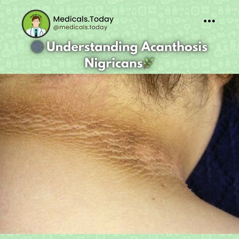 - Acanthosis nigricans is a skin condition characterized by dark, velvety patches, typically found in body folds like the neck, armpits, and groin. While it’s usually harmless, it can be a sign of underlying health issues. - Key Points: * Appearance: The affected skin may appear thickened and has a distinct dark coloration. * Causes: Commonly associated with insulin resistance, obesity, hormonal disorders, and certain medications. * Diagnosis: Diagnosis is primarily based on physical examin... Acanthosis Nigricans, Skin Condition, Insulin Resistance, Skin Conditions, Health Issues, A Sign, Physics, Conditioner, Medical