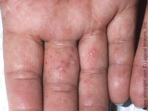 Rash On Hands, Itchy Hands, Skin Disorders, Skin Diseases, Nature Pictures, Left Hand, Tampa, Hair Hair, Skin Care