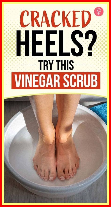 Soften Heels Diy, Home Remedy For Cracking Heels, Diy Heel Repair, Soft Heels How To Get, Cracked Feet Remedies Heels, How To Get Rid Of Heel Cracks, How To Soften Feet Heels, How To Remove Dry Skin From Heels, Heel Softener Remedies