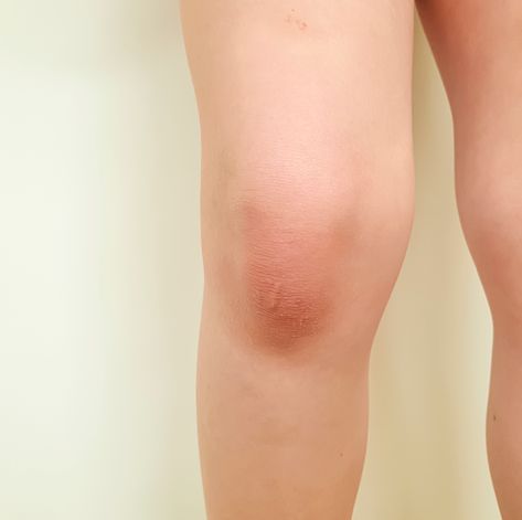 It's the largest joint in the body — and one of the most problem-prone. Swollen Knee, Knee Wraps, Below The Knee Dresses, Swollen Legs, Body Joints, Knee Exercises, Uric Acid, Sleep Health, Chronic Condition