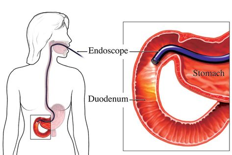 Endoscopy Procedure, Female Sterilization, Aspiration Pneumonia, Acanthosis Nigricans, Persistent Cough, Types Of Surgery, Mount Sinai, Laparoscopic Surgery, Medical Help