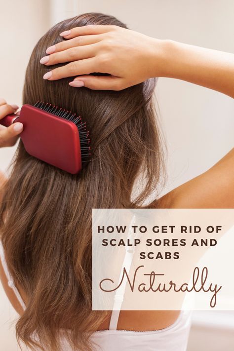 Sores On Scalp Remedies, Sebaceous Cysts On Head Scalp, Scabs On Scalp How To Get Rid Of, Scalp Breakouts Remedies, Scalp Sores How To Heal, Scabs On Scalp, Scalp Sores, Scalp Scabs, Scalp Bumps