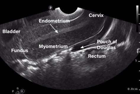 Uterus Ultrasound, Ultrasound Humor, Diagnostic Medical Sonography Student, Ultrasound School, Obstetric Ultrasound, Ultrasound Physics, Ultrasound Sonography, Sonography Student, Medical Ultrasound