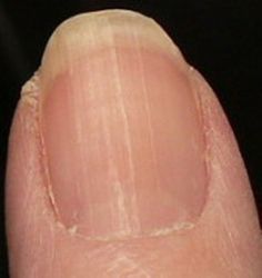 Moons On Fingernails, Ridges On Nails, Nail Health Problems, Nail Health Signs, Low Vitamin B12, Fingernail Health, Nail Disorders, Nail Ridges, Nail Problems