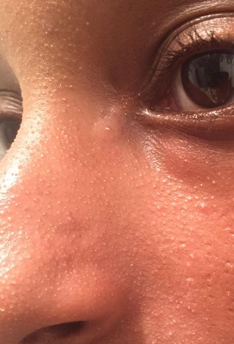 [Skin Concerns] How can i get rid of these tiny bumps on my nose? Ive tried everything How To Get Rid Of Nose Bump, How To Get Rid Of Tiny Bumps On Face, How To Get Rid Of Small Bumps On Face, Tiny Bumps On Face, Red Spots On Face, Reduce Face Redness, Red Skin Spots, Small Bumps On Face, Redness Pimple