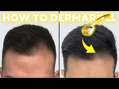 How to Derma Roll for Quickest Hair Results (Step-by-Step Guide) - YouTube Derma Rolling, Derma Roller, Quick Hairstyles, Hair Rollers, Step Guide, Hair Growth, Rolls, Hair Hair, Hair