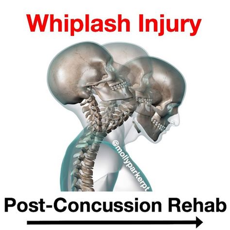 Dr. Mike Giardina, DPT, OCS on Instagram: “🚨WHIPLASH INJURY and REHAB PROGRESSION🚨 — Informative post by @mollyparkerpt on association between concussion and whiplash injury. — For a…” Whiplash Injury, Dr Mike, Whiplash, Lion Sculpture, On Instagram, Instagram