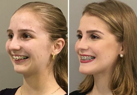 Esthetic Procedures, Beach Brunette, Forehead Reduction, Getting Braces, Facial Bones, Orthodontic Appliances, Jaw Surgery, Dental Fun, Clear Healthy Skin