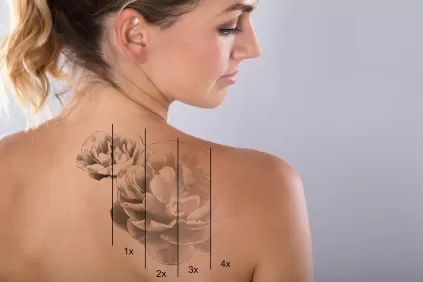 How to Lighten a Tattoo Naturally Without Pain | LoveToKnow Eyebrow Tattoo Removal, Tattoo Removal Cost, Laser Removal, Tattoo Cover Up, Tattoos For Black Skin, Laser Tattoo, Laser Tattoo Removal, Tattoo Cover-up, Eyebrow Tattoo