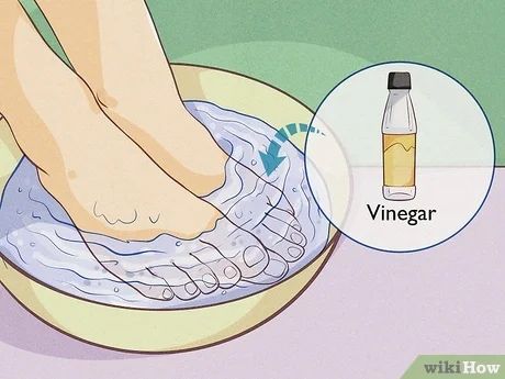 How to Prevent Smelly Feet (with Pictures) - wikiHow Stinky Feet Remedy, Sweat Gland, Foot Soak, Baby Powder, Antiperspirant, Rubbing Alcohol, The Body, Healing, Health