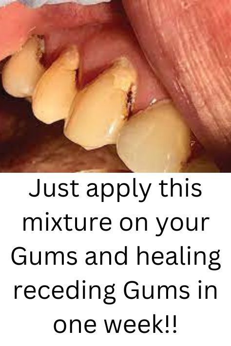 Tooth Decay Remedies, Teeth Whitening Remedies, Teeth Whitening Diy, Teeth Health, How To Prevent Cavities, Gum Care, Oral Care Routine, Receding Gums, Gum Health