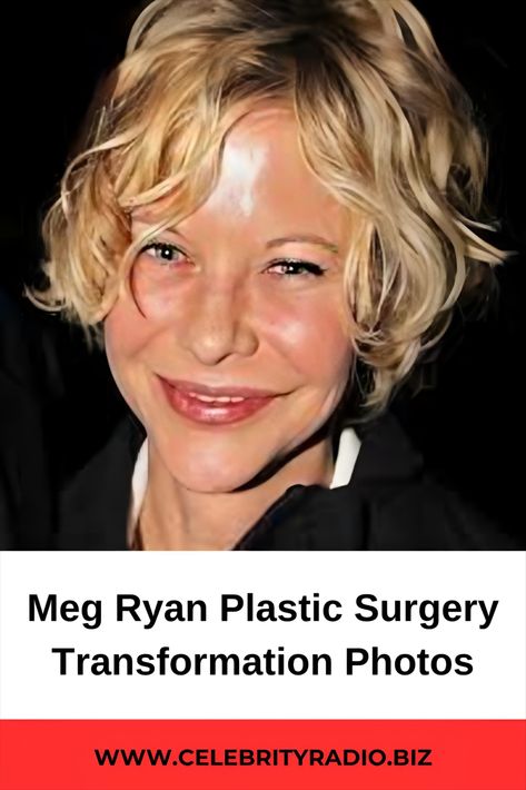 Meg Ryan Plastic Surgery Transformation photos Meg Ryan Now, Plastic Surgery Fails, Plastic Surgery Fail, Plastic Surgery Gone Wrong, Body Makeover, Blonde Hair Transformations, Celebrity Plastic Surgery, Meg Ryan, Under The Knife