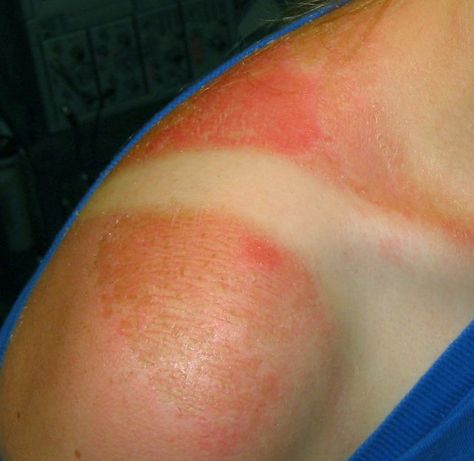 The Single Most Effective Way to Get Rid of a Sunburn: This is my first instructable, and is only going to be short because its an extremely easy and effective method to removing a painful sunburn. This method was recommended to me by my friends mother, who is a nurse. I hope this helps many a painful… Sunburn Pictures, Sunburn Blisters, Get Rid Of Sunburn, How To Treat Sunburn, Bad Sunburn, Sunburn Relief, Calendula Benefits, Banana Benefits, Matcha Benefits