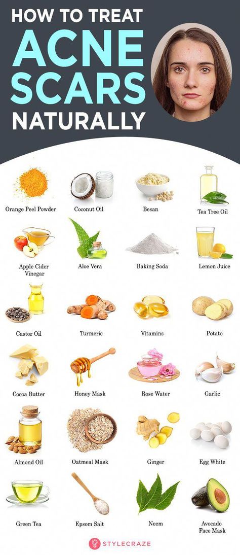 Natural remedies are an effective alternative to surgery or harsh techniques for treating acne scars. These 12 remedies can help lighten your scars gently. Remedies For Back Acne, Natural Cold Sore Remedy, Baking Soda Lemon Juice, Oatmeal Mask, Back Acne Remedies, Sensitive Acne Prone Skin, Back Acne, Acne Prone Skin Care, Treating Acne