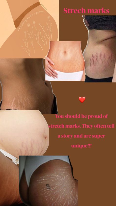 We should normalize stretch marks. They are nothing to be ashamed of Stretch Mark Positivity, Stretchmarks Beautiful, Neck Pimples, Skin Glow Tips, Workout Advice, Best Peel Off Mask, Strech Marks, Twist Curls, Skin Bumps