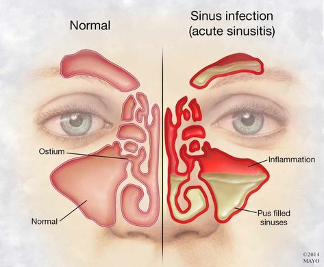 Treating Sinus Infections Without Antibiotics – Mayo Clinic News Network Treating Sinus Infection, Relieve Sinus Congestion, Acute Sinusitis, Remedy For Sinus Congestion, Sinus Inflammation, Sinus Remedies, Home Remedies For Sinus, Maxillary Sinus, Sinus Congestion Relief