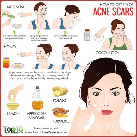 how to get rid of acne scars http://www.scarrcreams.com/different-scar-types/ Aloe Vera Acne, Scar Remedies, Get Rid Of Acne, Rid Of Acne, Natural Acne Remedies, Natural Acne, Home Remedies For Acne, Acne Scar Removal, Acne Breakout