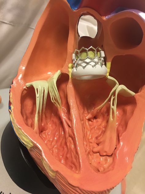 Arteries Anatomy, Cardiac Sonography, Aortic Valve Replacement, Interventional Cardiology, Heart Valves, Open Heart Surgery, Cardiac Nursing, Heart Anatomy, Coronary Arteries