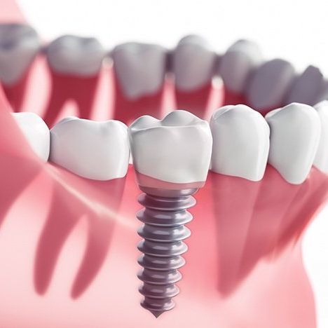 Implant Dental, Dental Photos, Dental Implant Procedure, Implant Dentist, Best Dental Implants, Dental Photography, Restorative Dentistry, Implant Dentistry, Teeth Implants