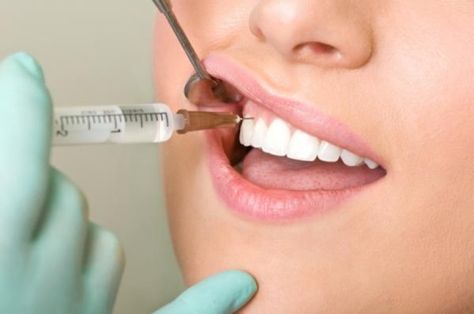 Tooth Extraction Aftercare, Local Anesthesia, Cosmetic Dentistry Procedures, Dental World, Dental Hygiene School, Dental Facts, Dental Life, Dental Marketing, Emergency Dentist