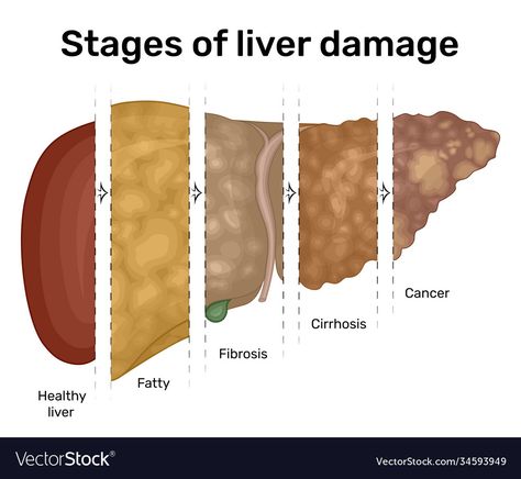 Stage 3 Liver Fibrosis, Cirrhotic Liver, Liver Illustration, Liver Fibrosis, Liver Anatomy, Healthy Liver Diet, Liver Detox Diet, Liver Diet, 7 Day Challenge