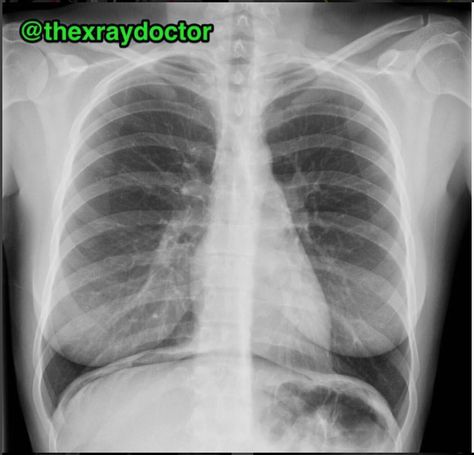 Respiratory Acidosis, Xray Art, Pleural Effusion, X-ray Images, Back Stretches For Pain, Preventative Health, Buddha Image, Money And Happiness, School Of Medicine